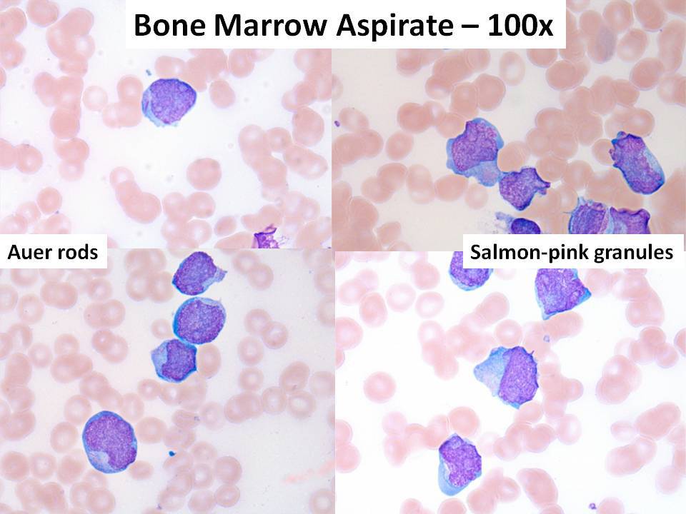 Bone marrow aspirate - 100x